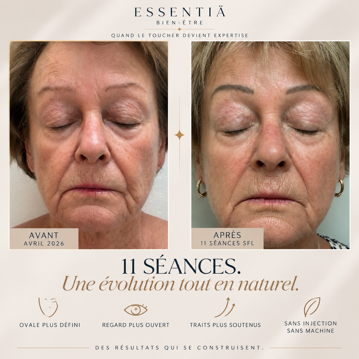 Résultat avant-après Sculptural Face Lifting 1