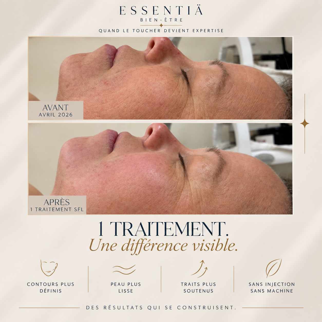 Résultat avant-après Sculptural Face Lifting 2