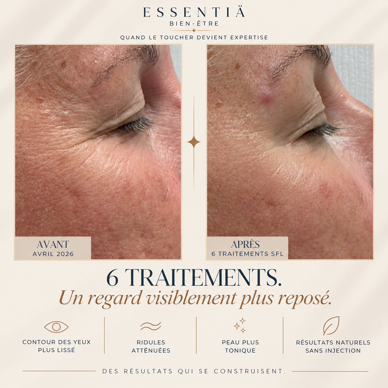 Résultat avant-après Sculptural Face Lifting 3