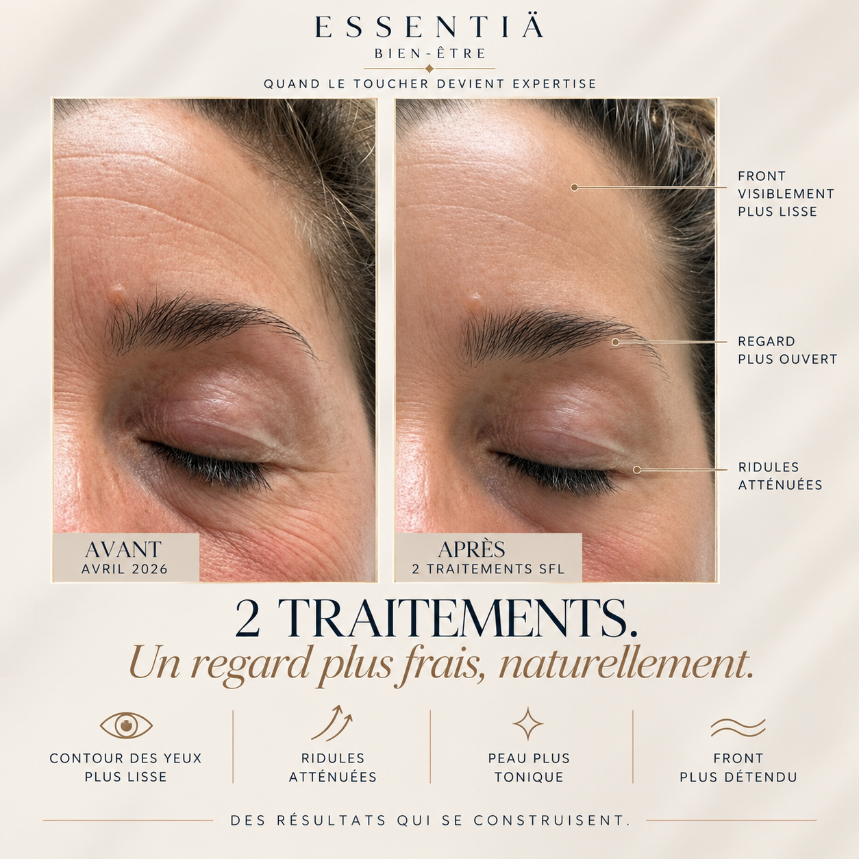 Résultat avant-après Sculptural Face Lifting 4