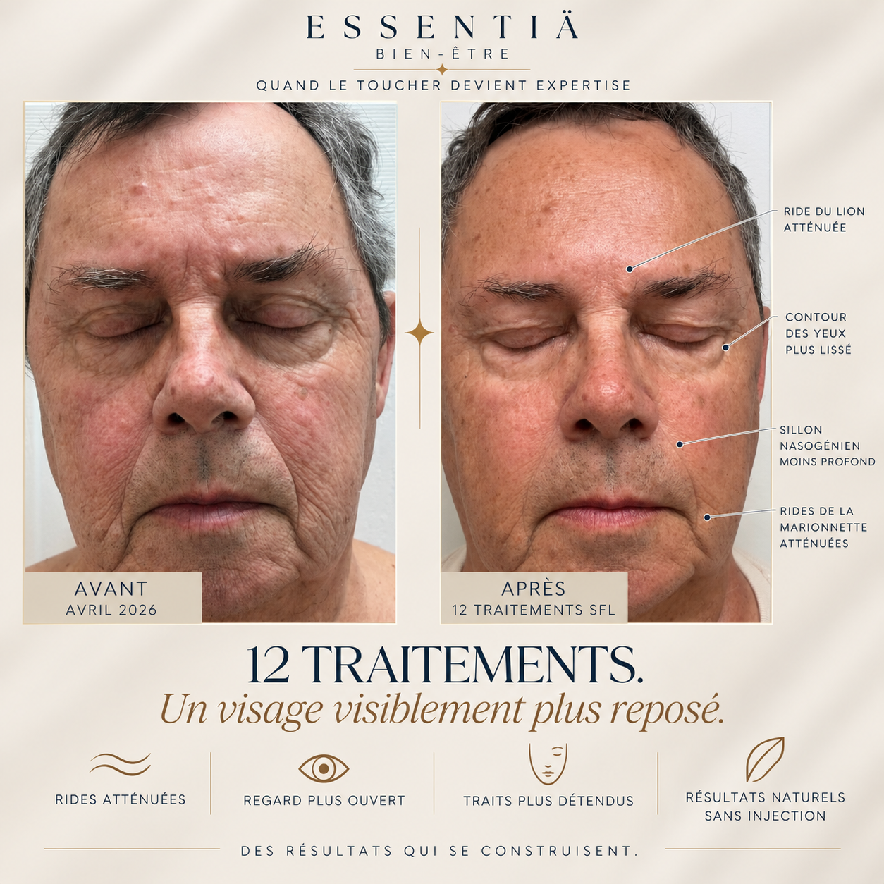 Résultat avant-après Sculptural Face Lifting 5