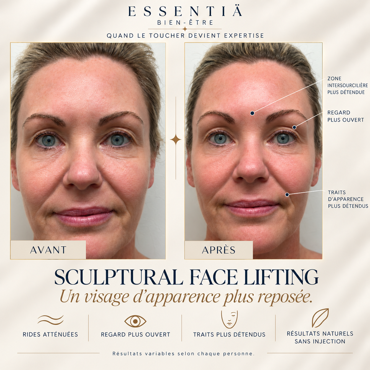Résultat avant-après Sculptural Face Lifting 6
