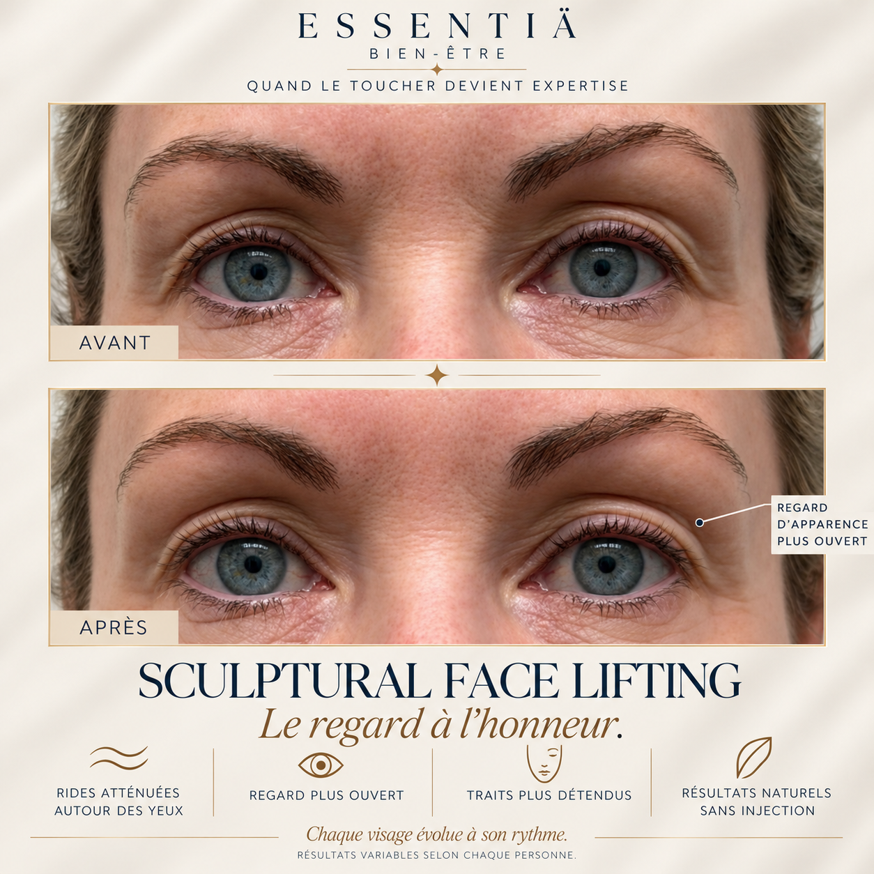 Résultat avant-après Sculptural Face Lifting 7