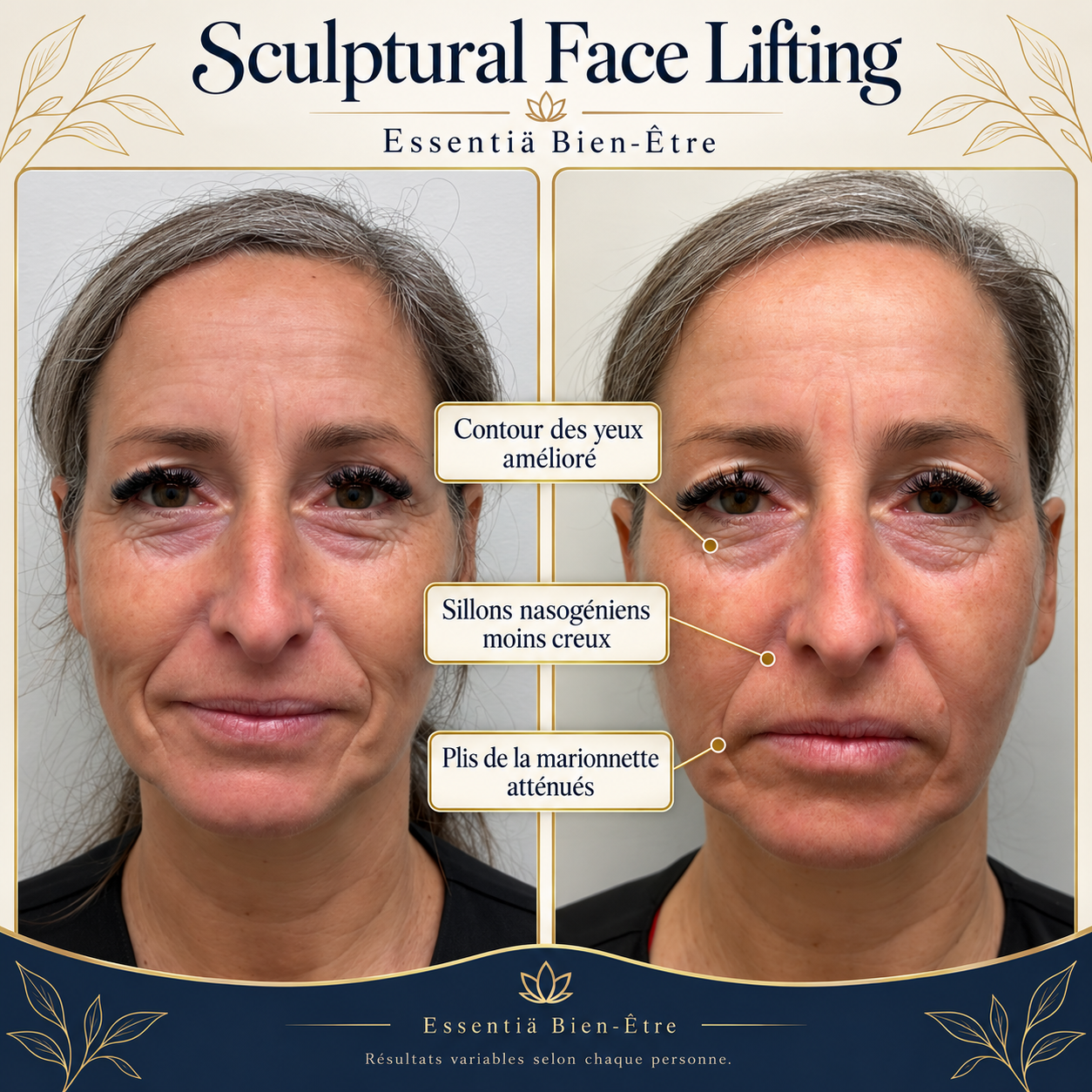 Résultat avant-après Sculptural Face Lifting 8